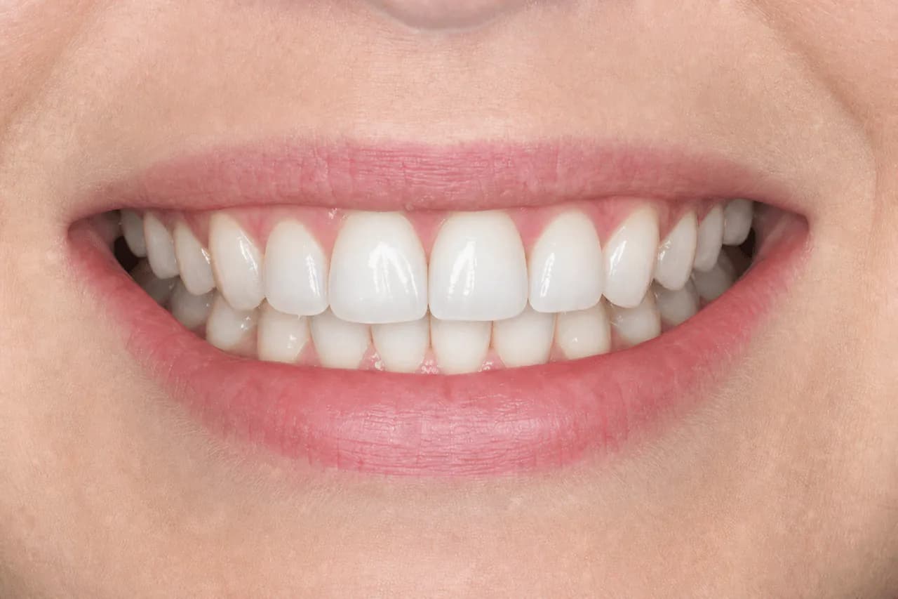 After — Tek diş implant restorasyonu