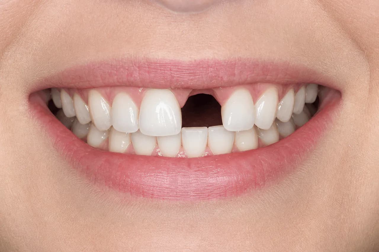 Before — Tek diş implant restorasyonu