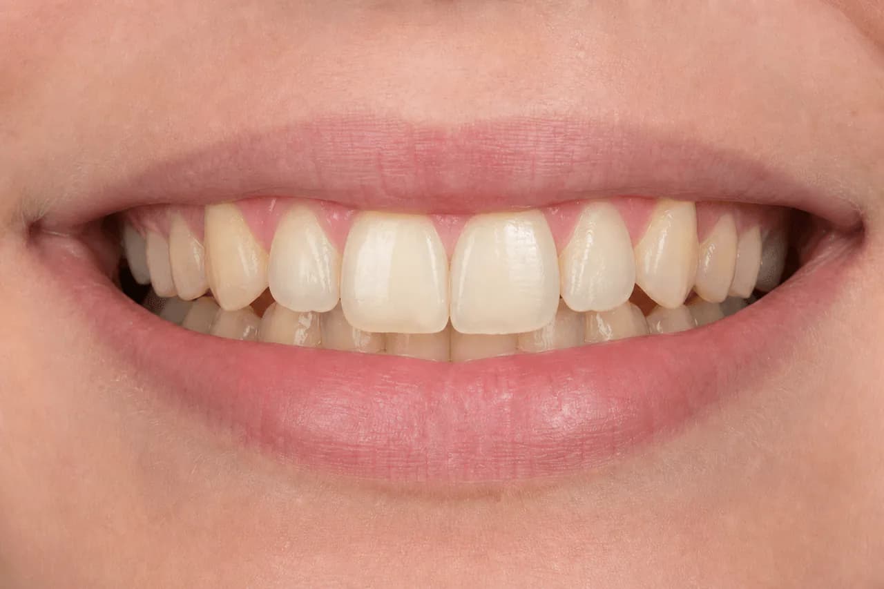 After — Ön diş kırığı onarımı