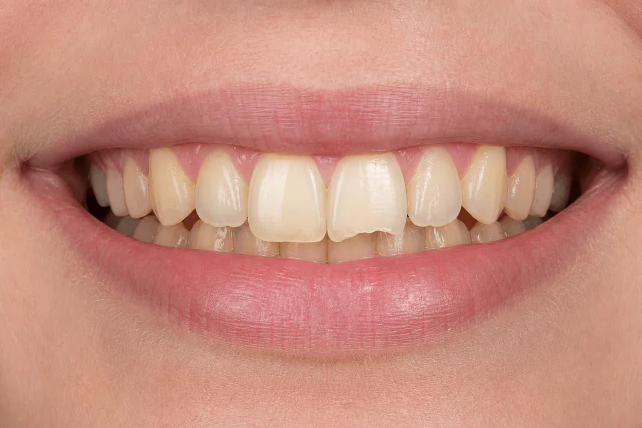 Before — Ön diş kırığı onarımı