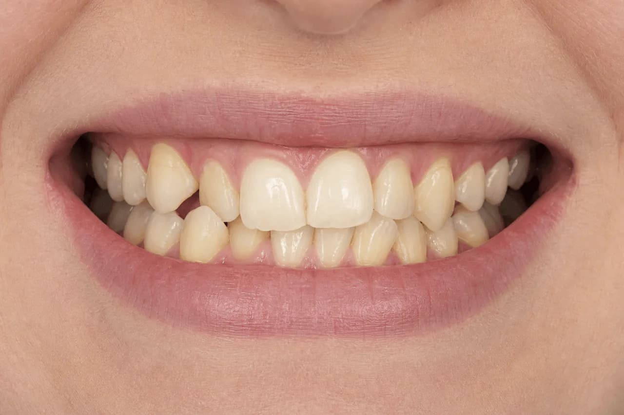 Before — Şeffaf plak ortodontisi