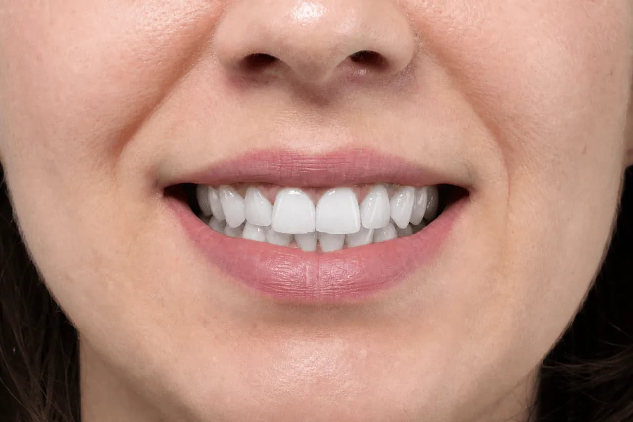 After — Professional teeth whitening