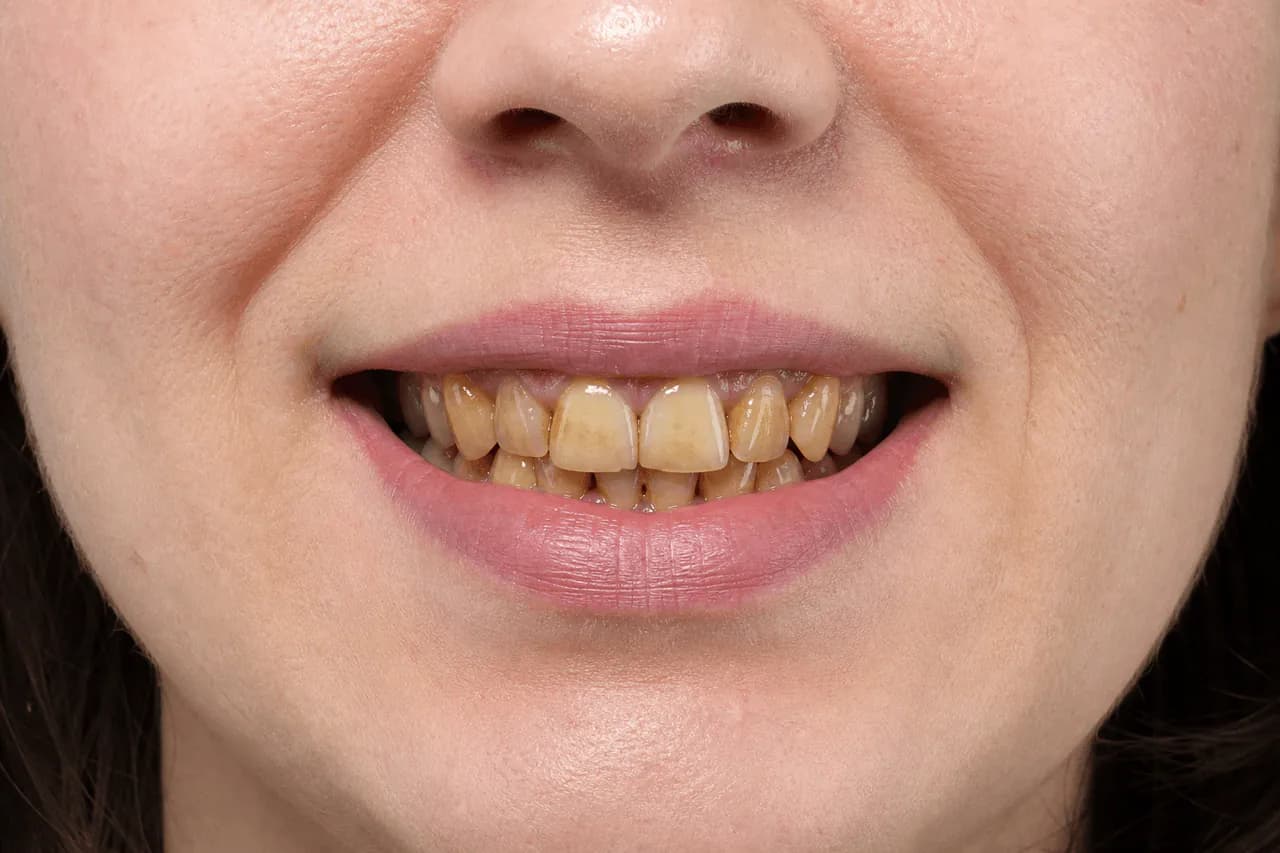 Before — Professional teeth whitening